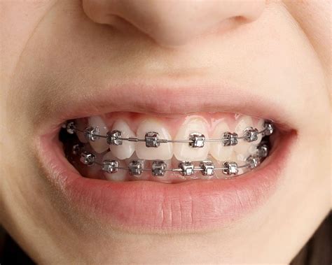 brackets metalico|brackets de metal.